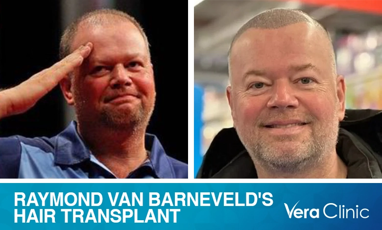 Raymond van Barneveld Hair Transplant