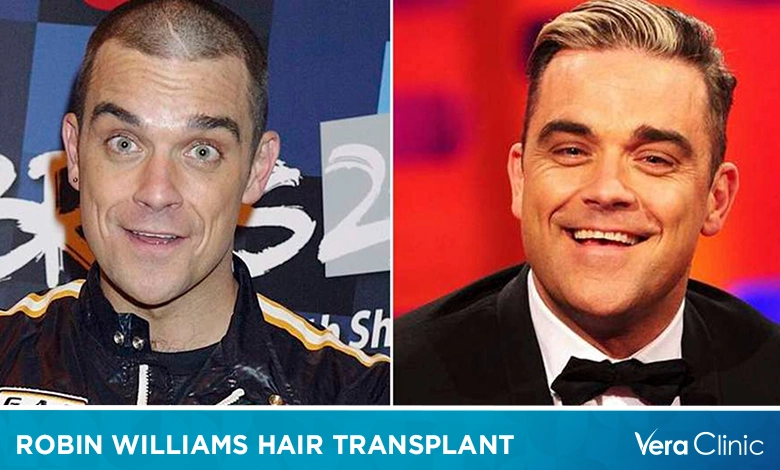 Robin Williams Hair Transplant