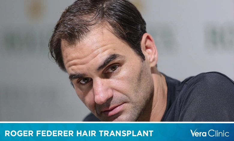 Roger Federer Hair Transplant