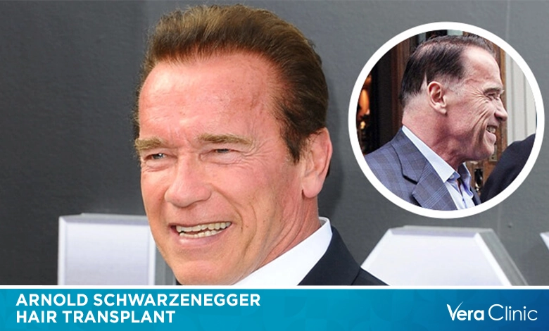 Arnold Schwarzenegger Hair Transplant