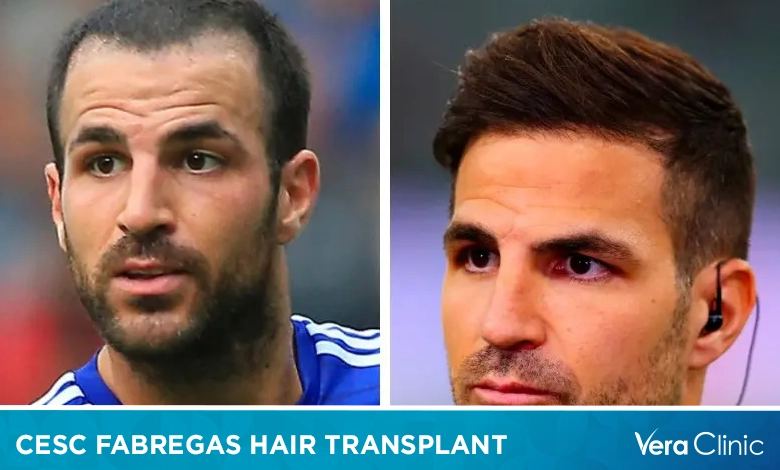 Cesc Fabregas Hair Transplant