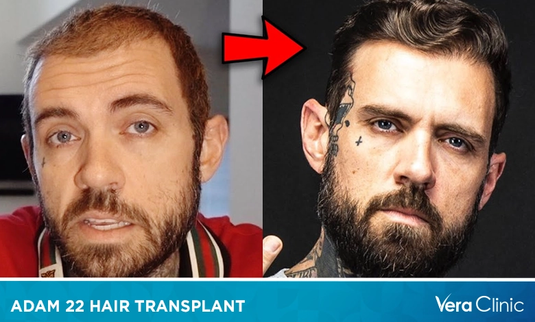 Adam 22 Hair Transplant