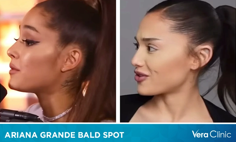 Ariana Grande Bald Spot