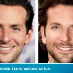Bradley Cooper Teeth