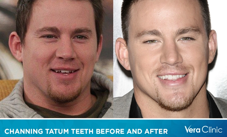 Channing Tatum Teeth Before and After