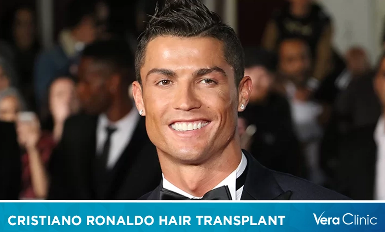 Cristiano Ronaldo Hair Transplant