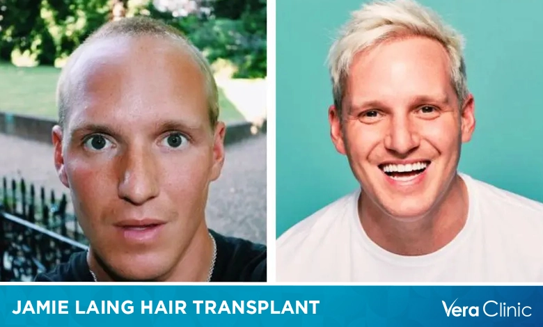 Jamie Laing Hair Transplant