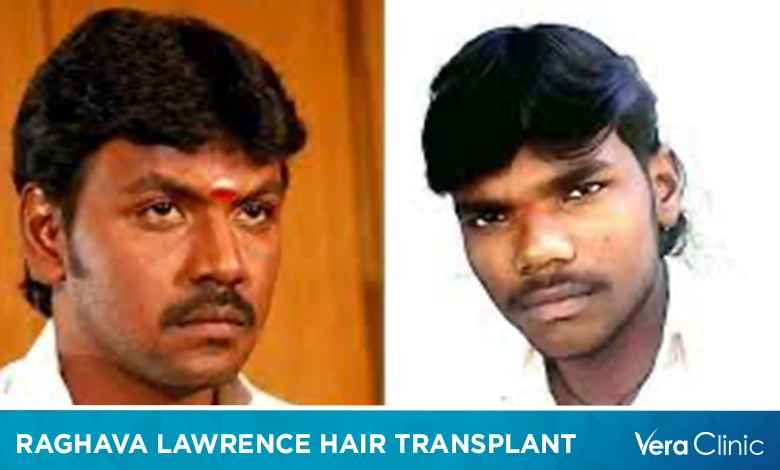 Raghava Lawrence Hair Transplant