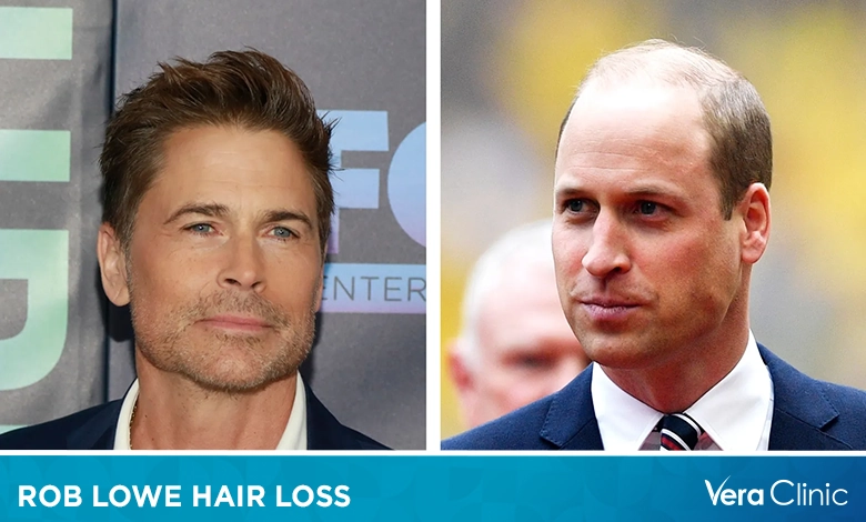 Rob Lowe Hair Loss