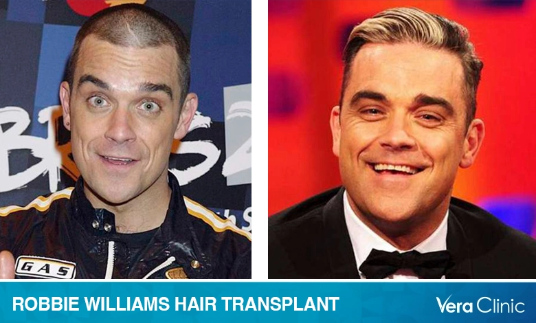 Robbie Williams Hair Transplant