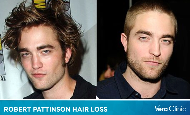 Robert Pattinson Hair Loss