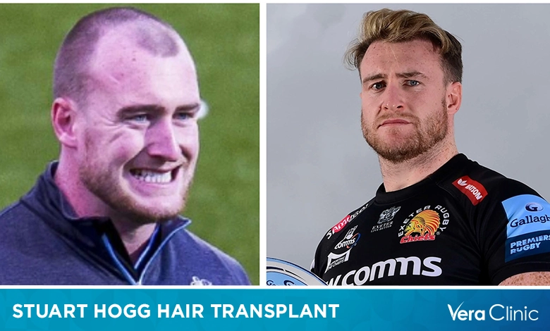 Stuart Hogg Hair Transplant