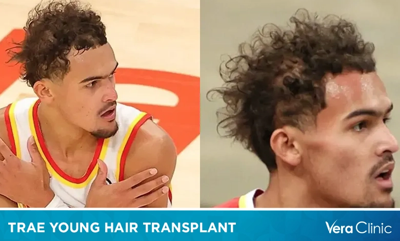 Trae Young Hair Transplant