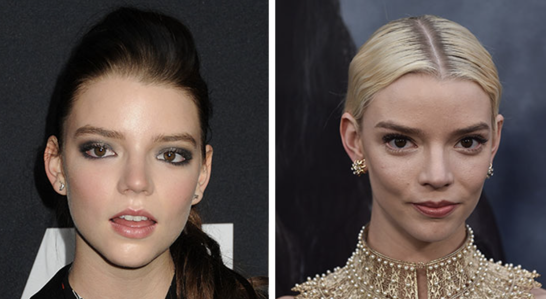 Anya TaylorJoy Plastic Surgery Unveiling the Star
