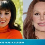 Marlo Thomas Plastic Surgery