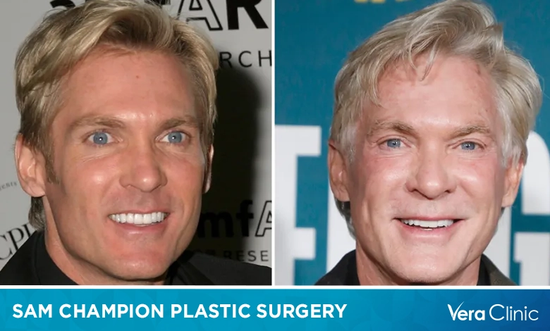 Sam Champion Plastic Surgery
