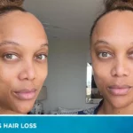 Tyra Banks Hair Loss