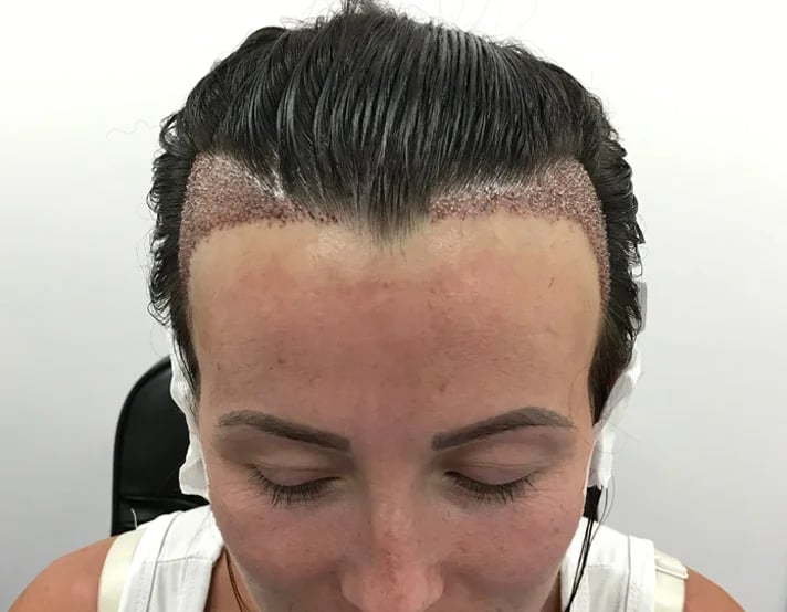 Qu'est-ce que la greffe de cheveux FUE ?