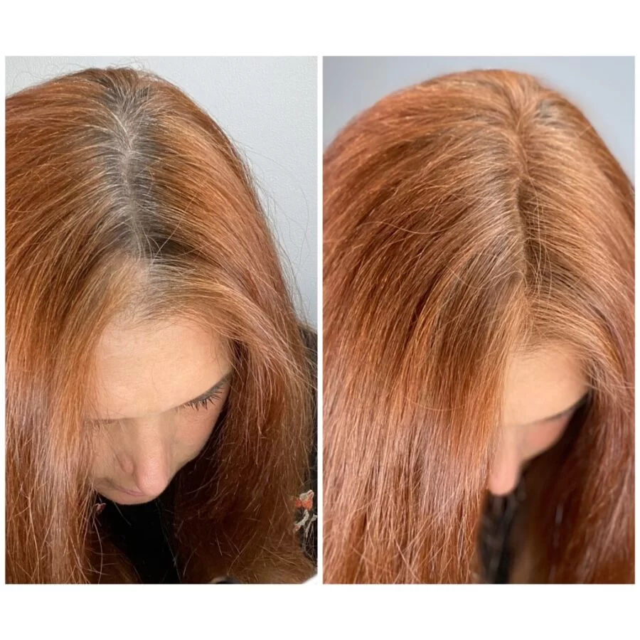 La Repousse des Cheveux Espoir et Solutions Après la Chimio et Audelà