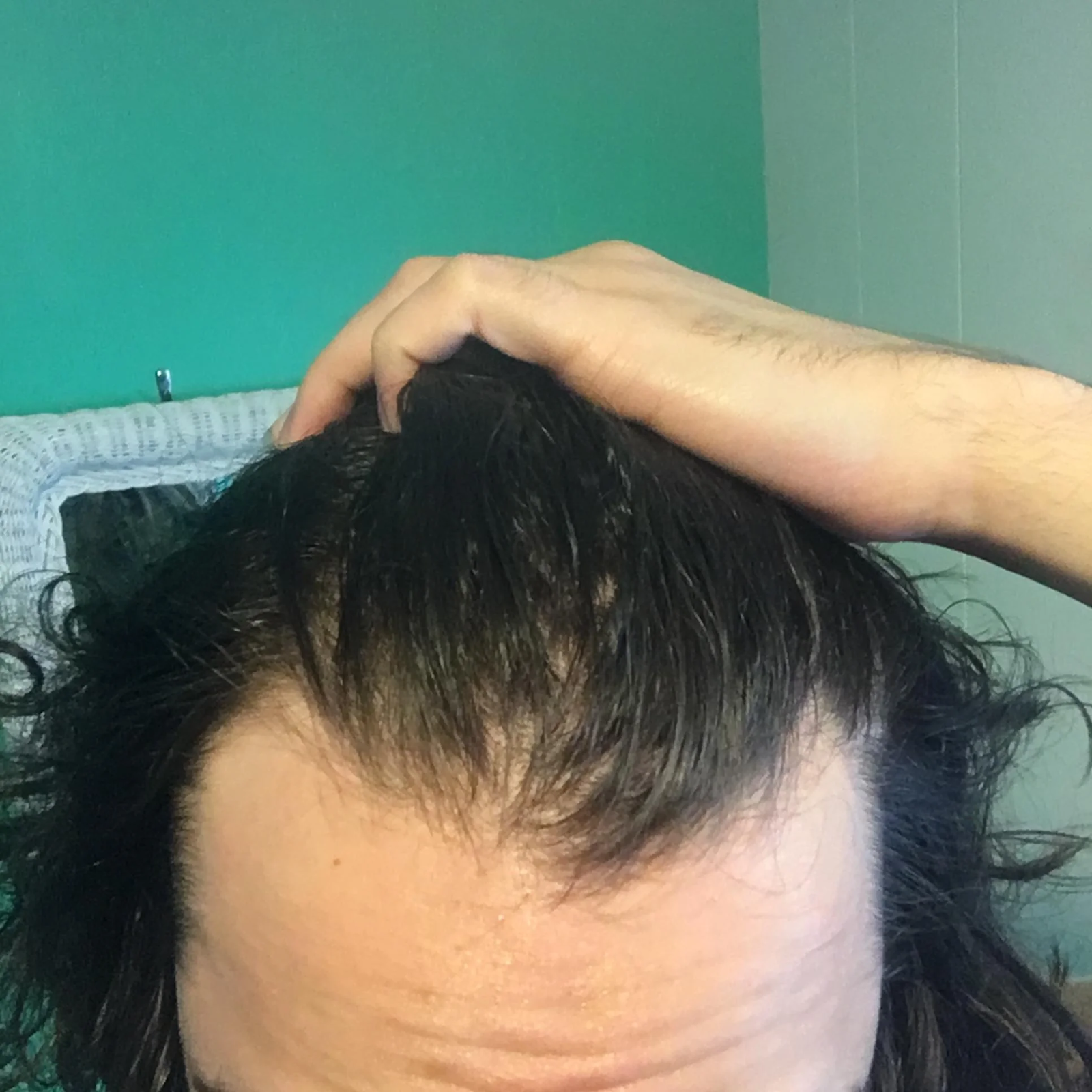How To Embrace Your Bell Shaped Hairline (And Look Amazing!) - o9zihgk