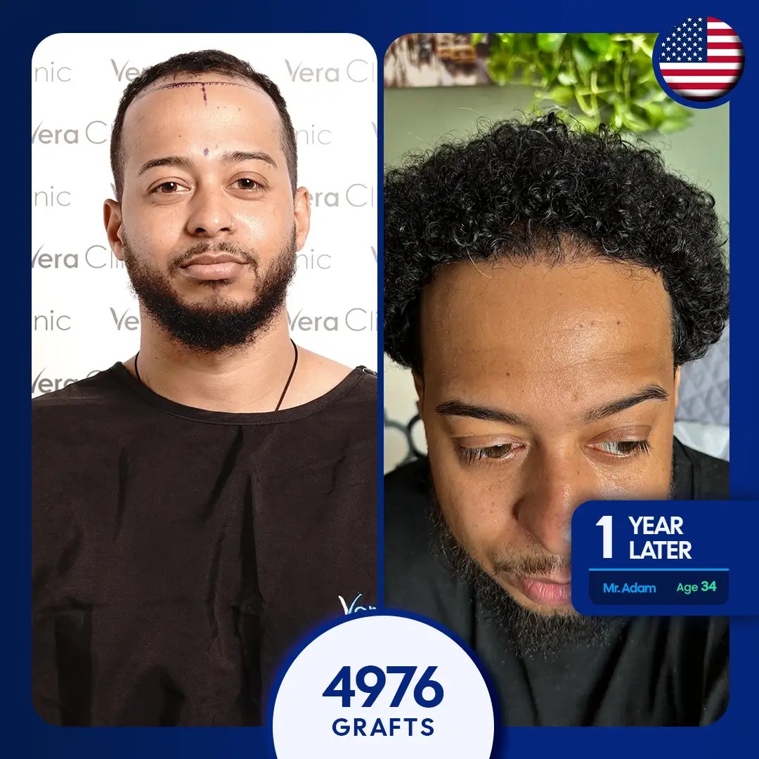 5000 afro hair transplant for receding hairline, traction alopecia