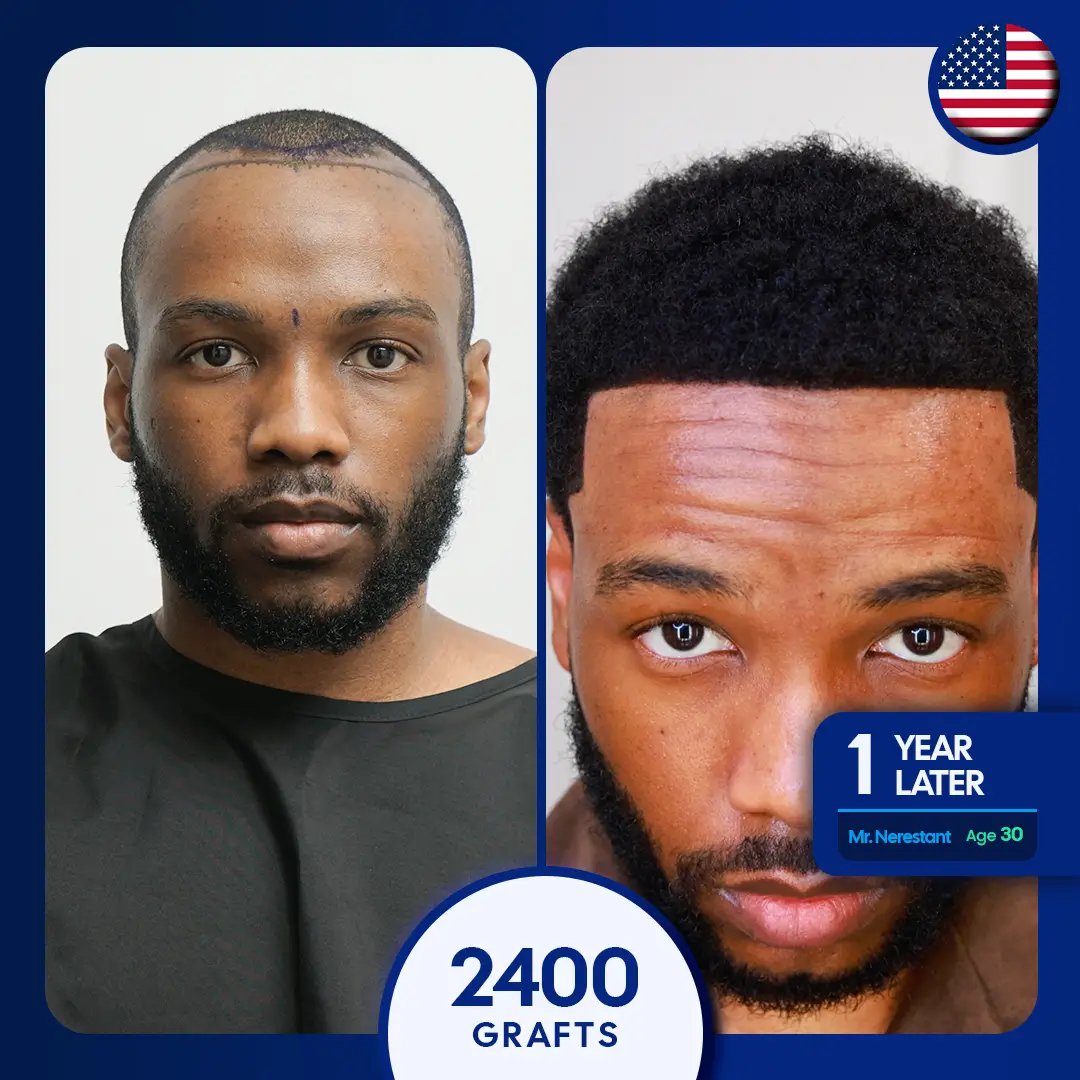 2400 afro hair transplant, hairline