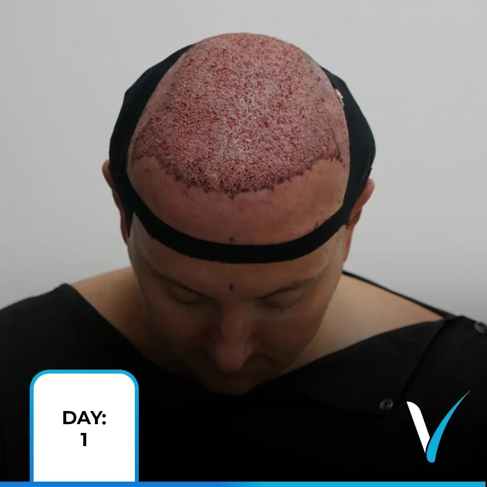 Hair transplant growth stages