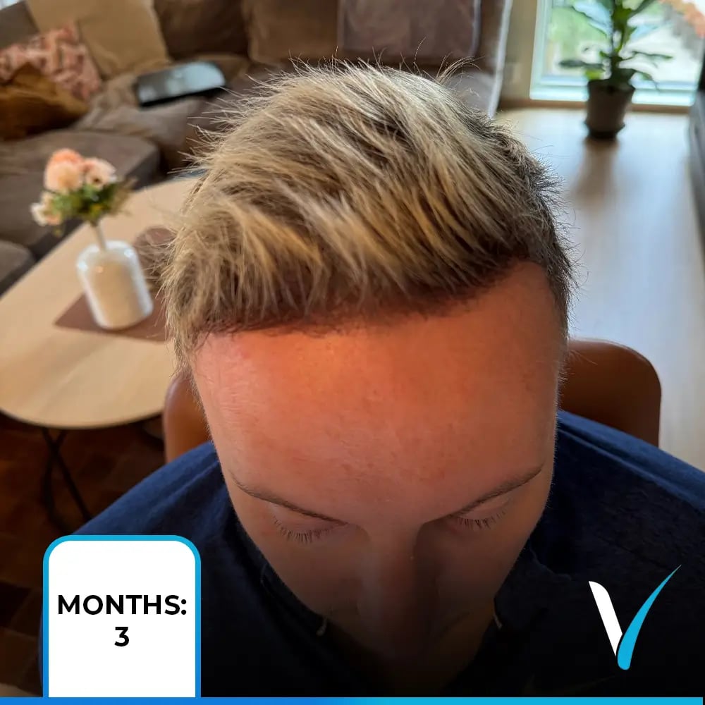 Les cheveux repoussent après une greffe capillaire.