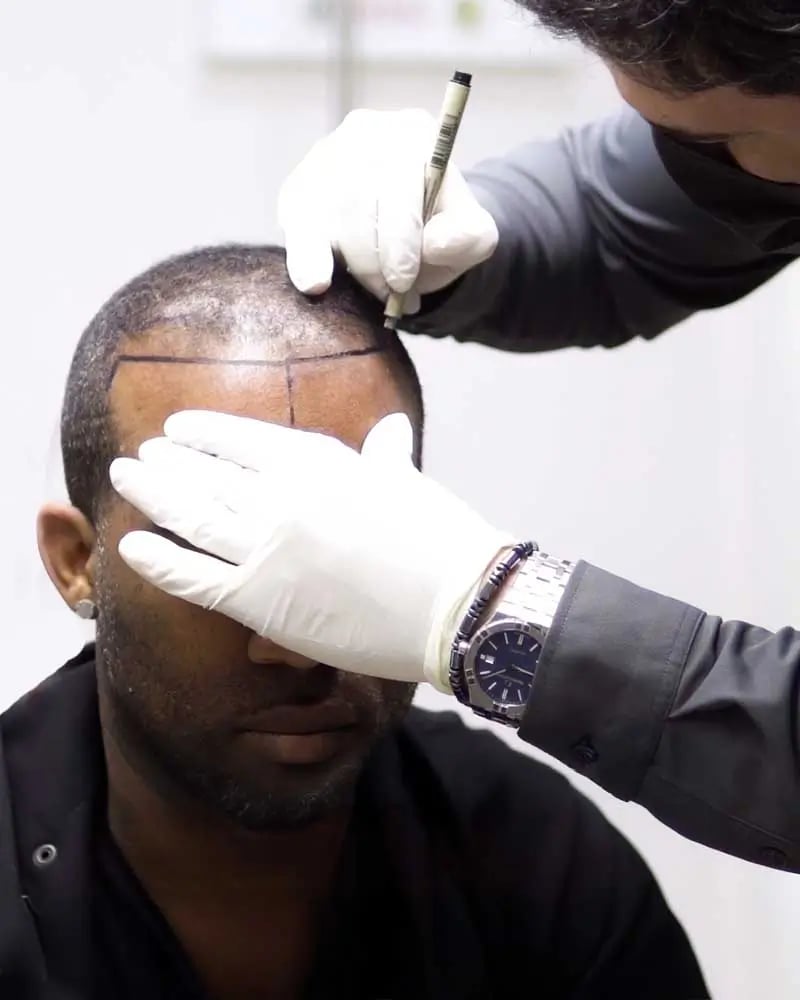 Trasplante de pelo afro en Turquía