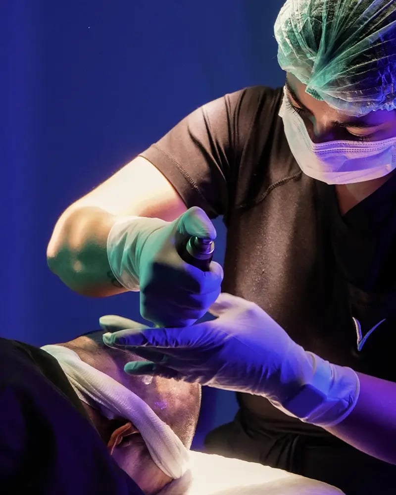 Cost of DHI Hair Transplant in Turkey