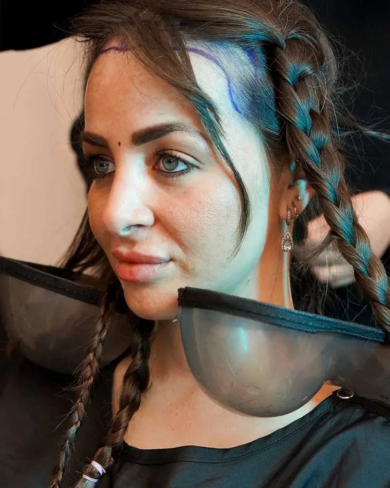 Trasplante capilar femenino en Turquía
