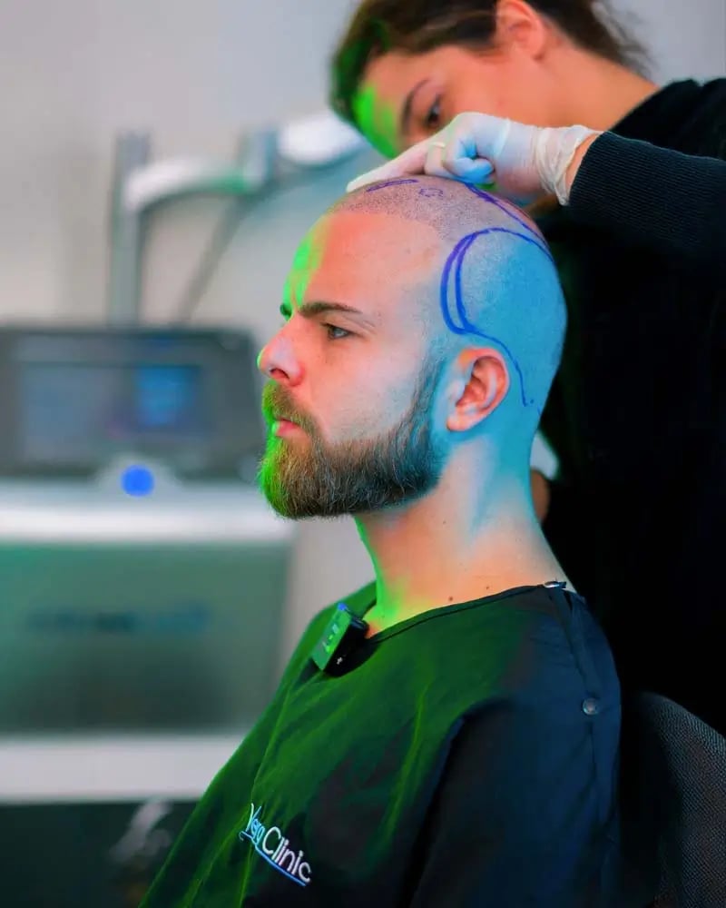 Cost of Micro-FUE Hair Transplant in Turkey