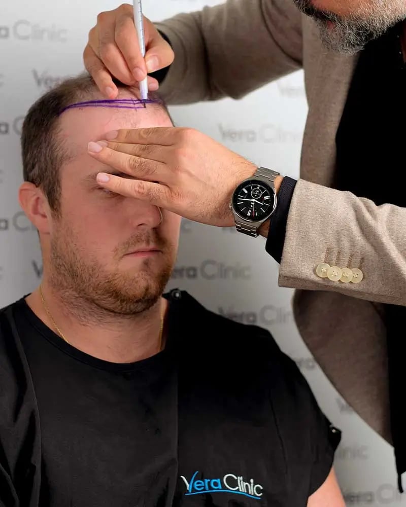 Stem Cell–Based Hair Transplant Costs in Turkey