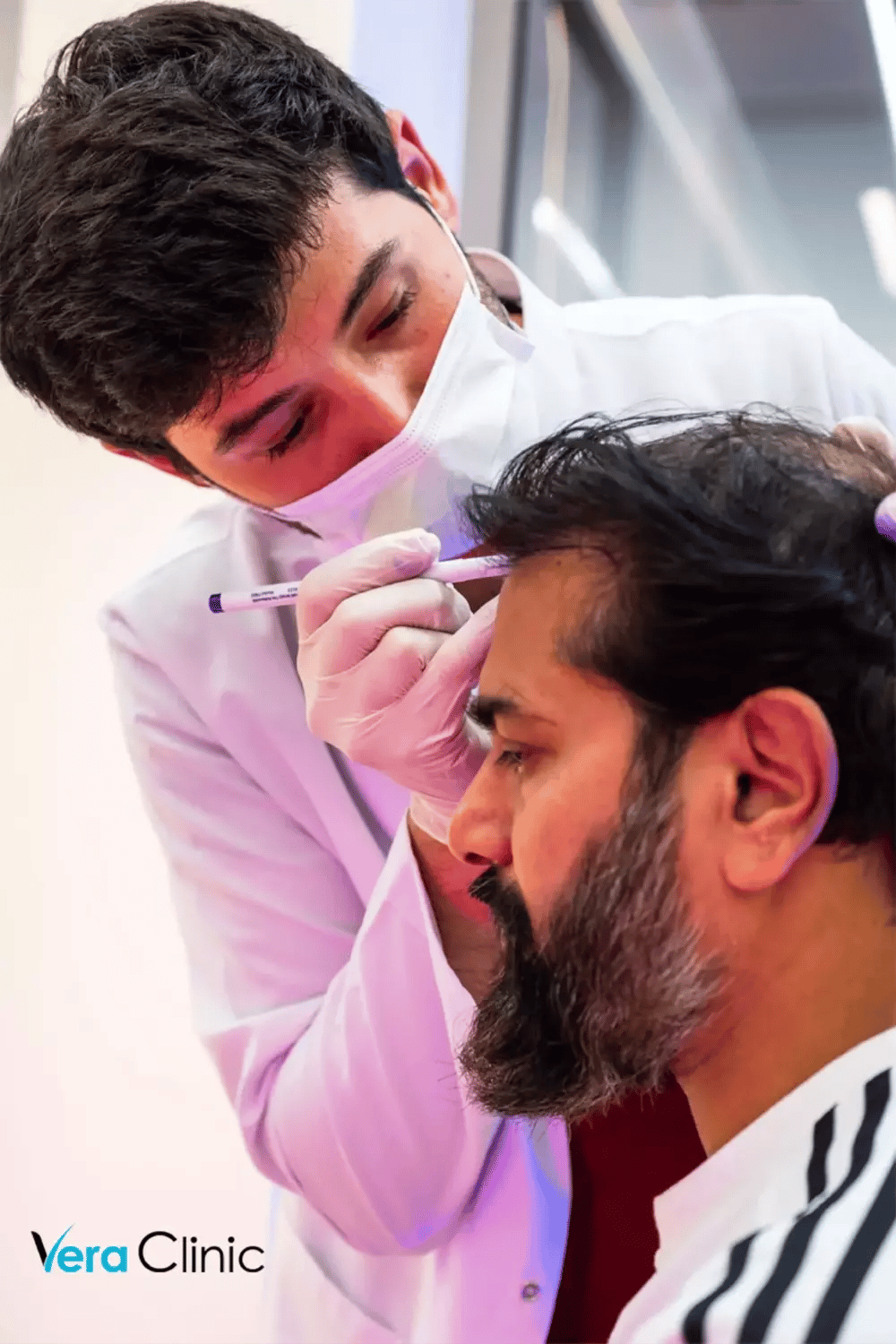 Drawing hairline for DHI hair transplant