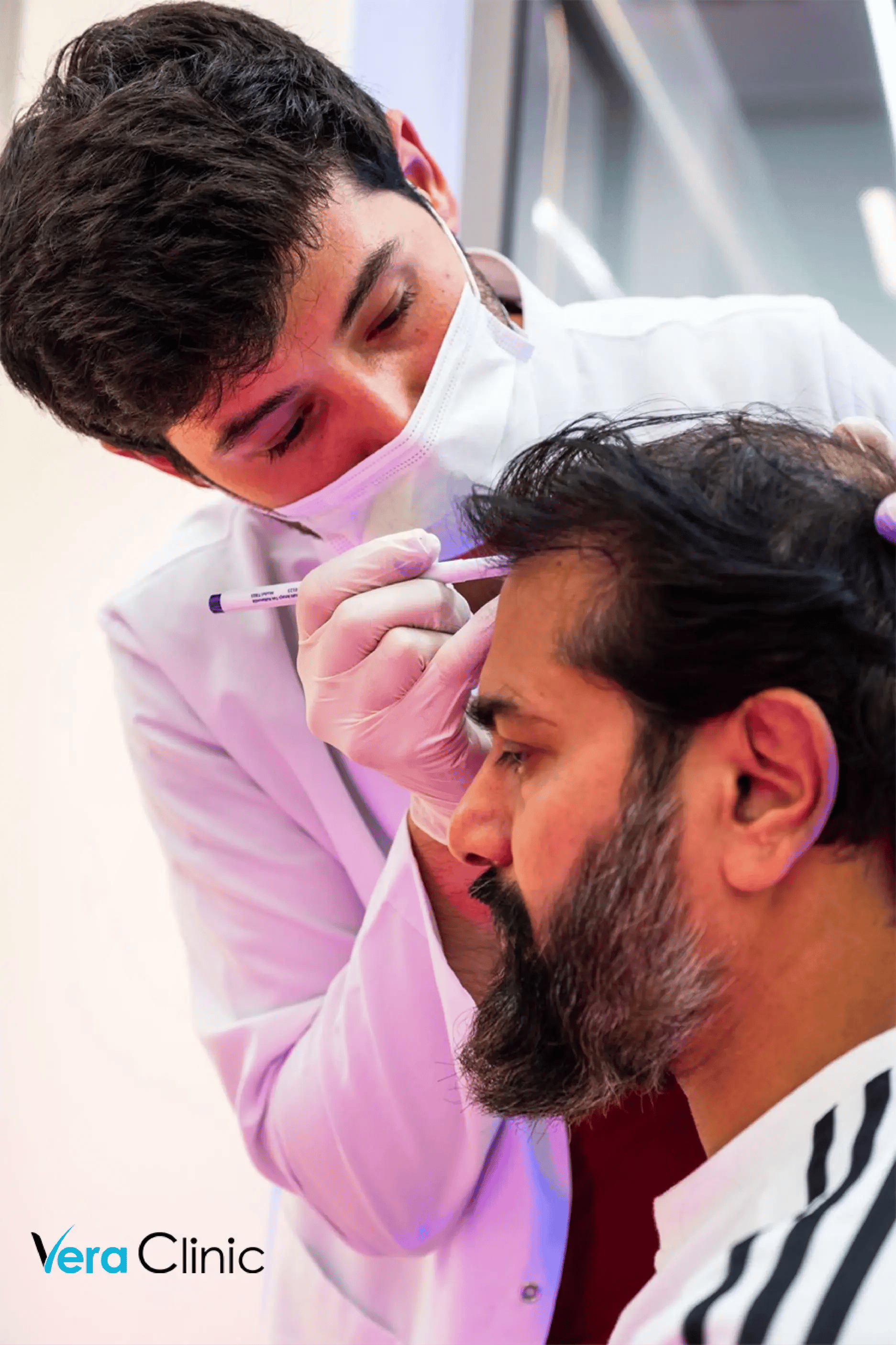 Drawing hairline for DHI hair transplant