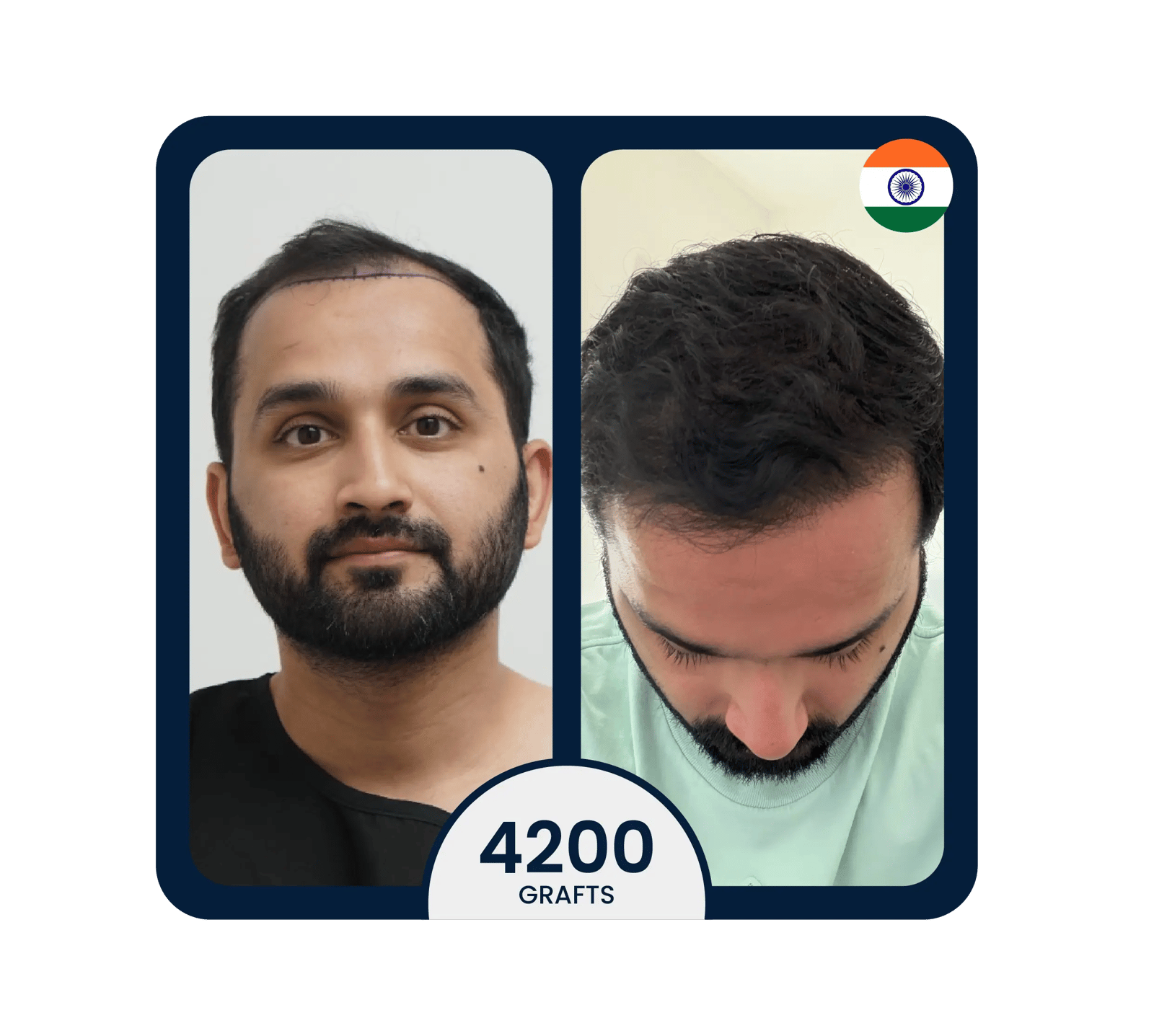 زراعة الشعر بالطريقة الدقيقة FUE قبل وبعد 4200 بصيلة
