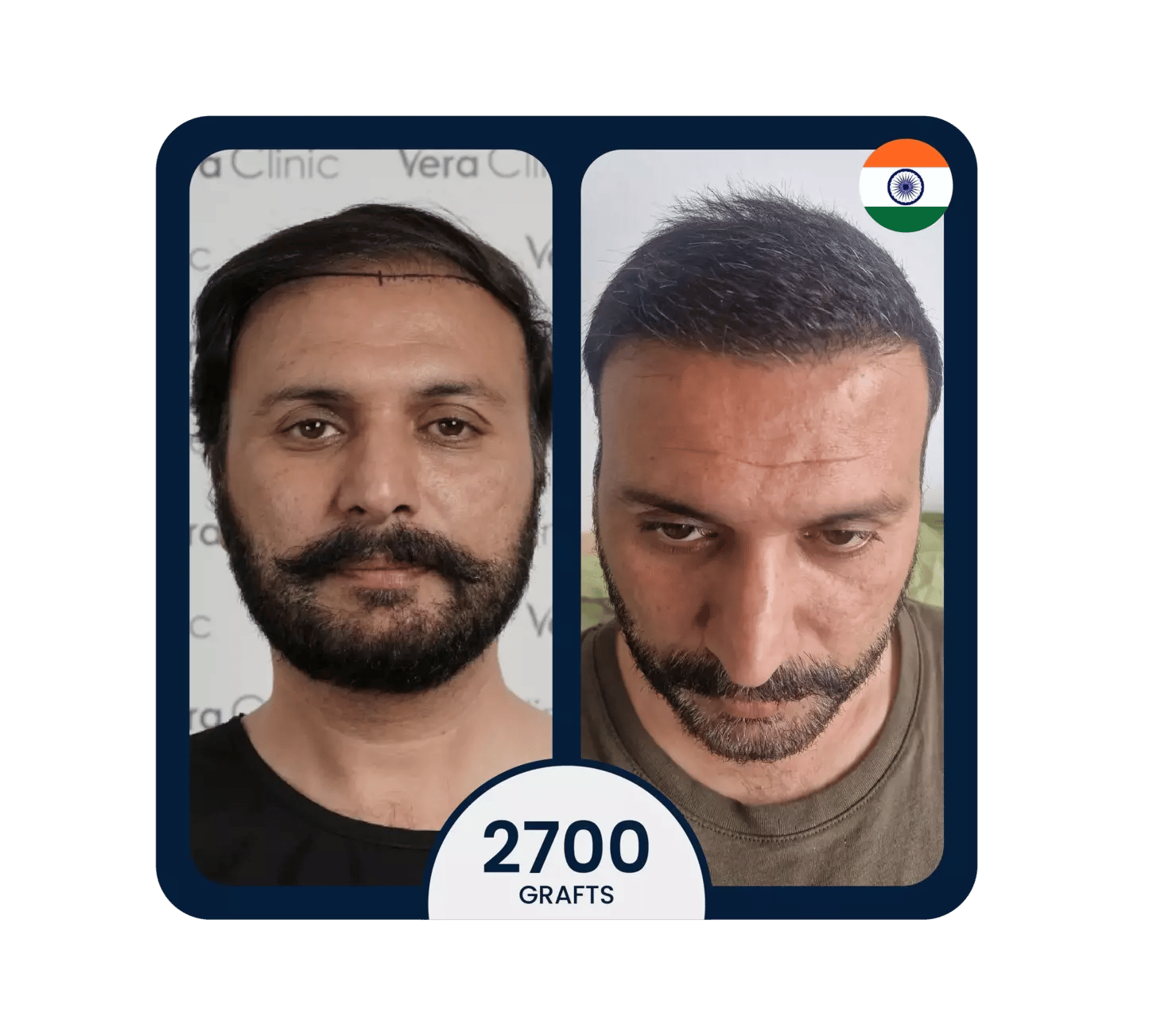 زراعة الشعر بالطريقة الميكروية FUE قبل وبعد 2700 بصيلة
