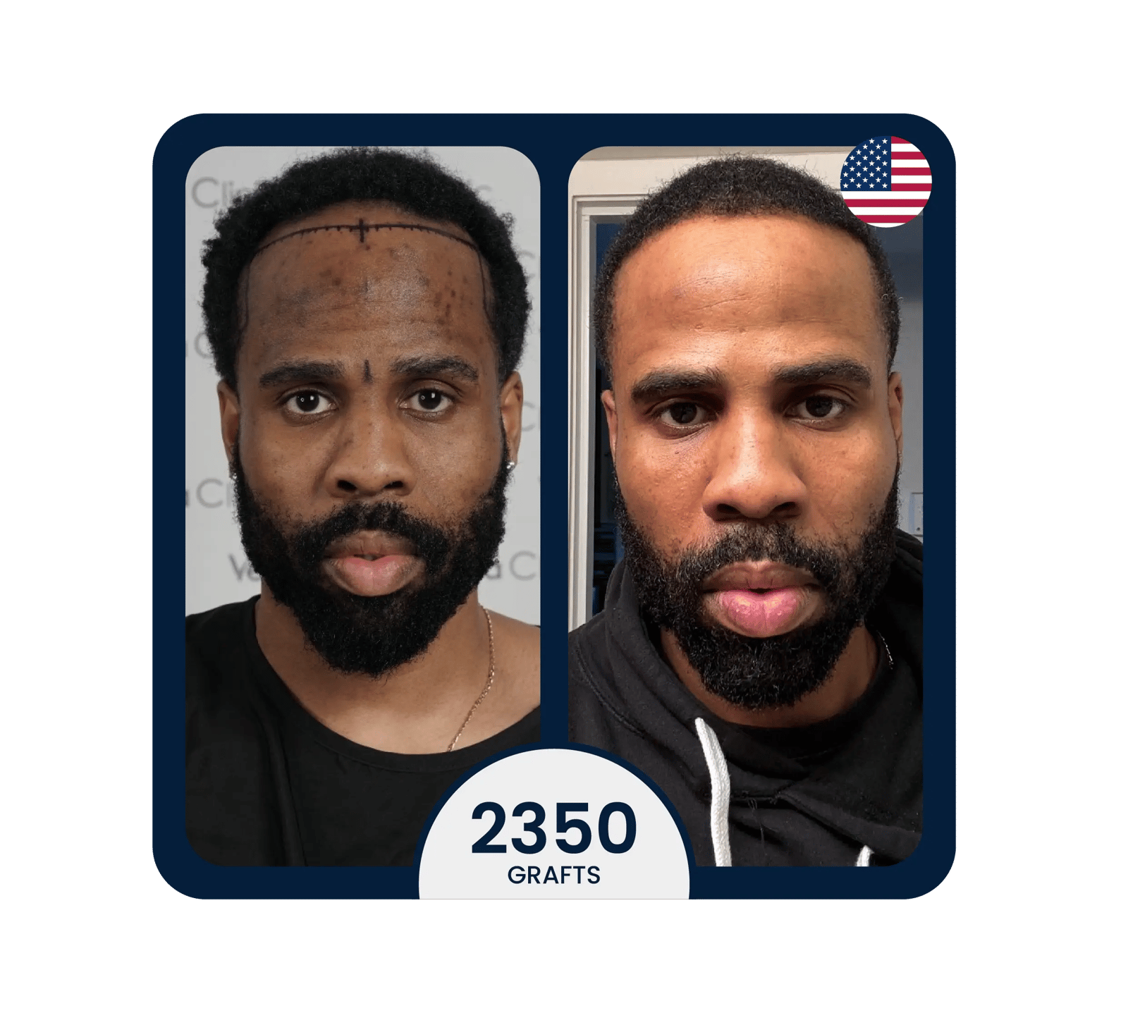 Micro FUE hair transplant before after 2350 grafts