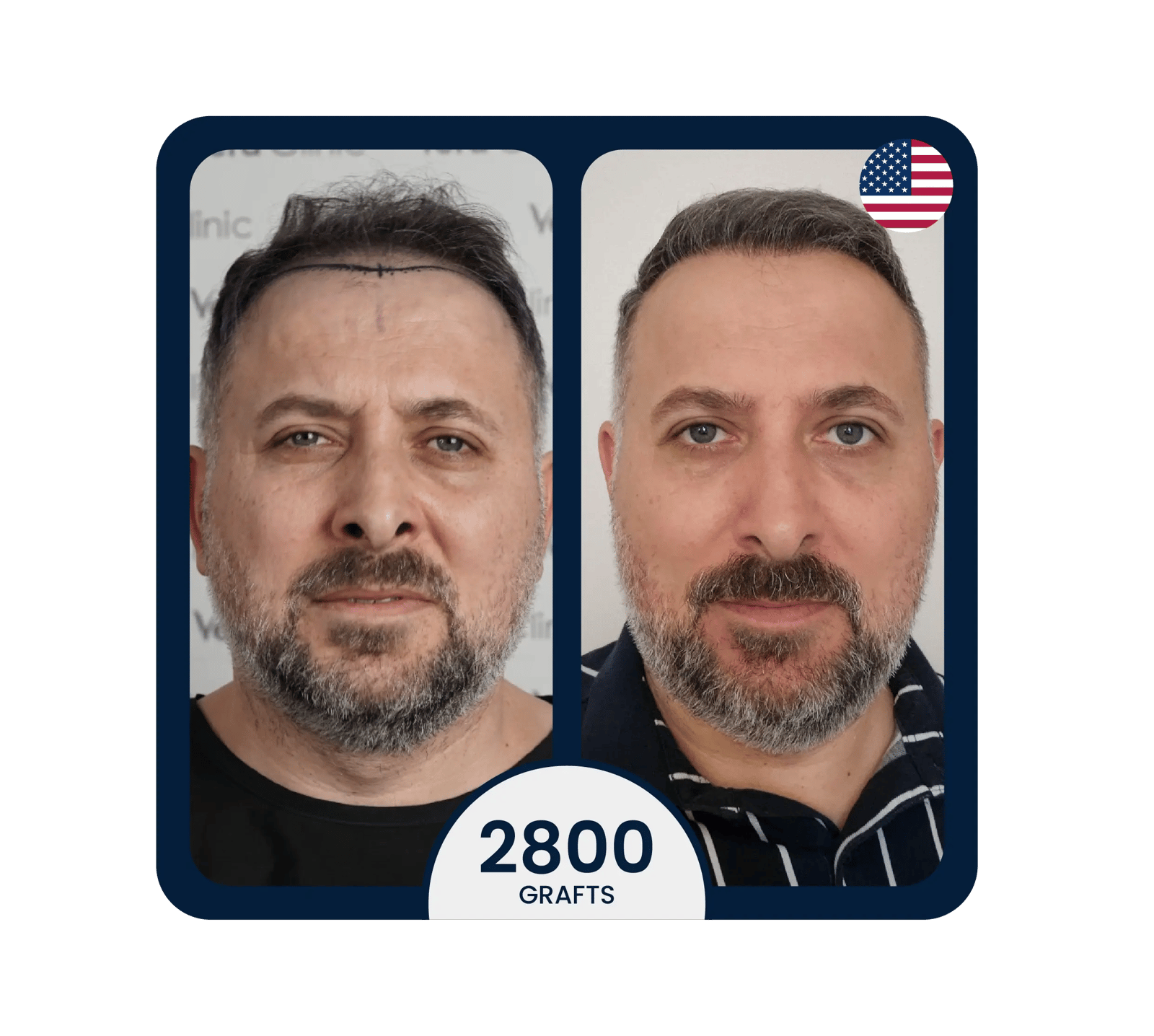 Micro FUE hair transplant before after 2800 grafts
