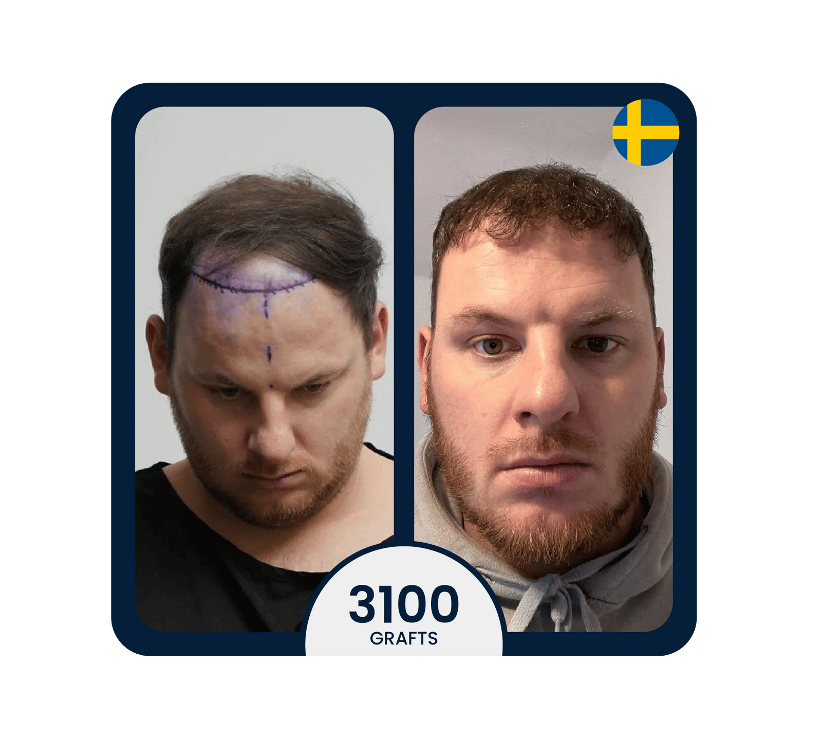 Micro FUE hair transplant before after 3100 grafts