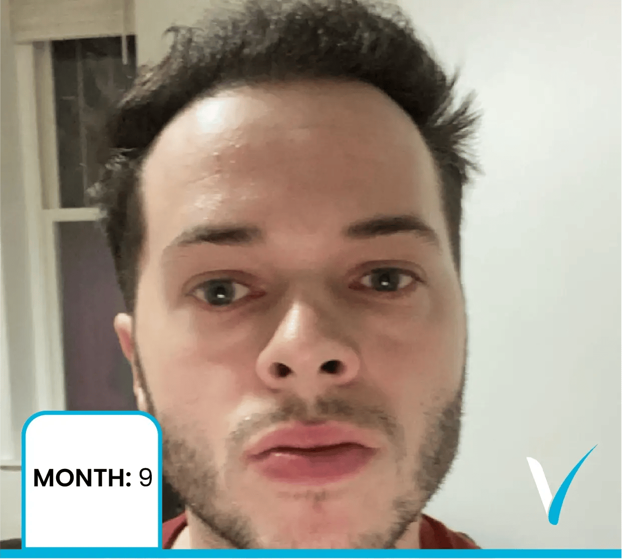 نتائج زراعة الشعر بالطريقة الدقيقة بعد 6 أشهر