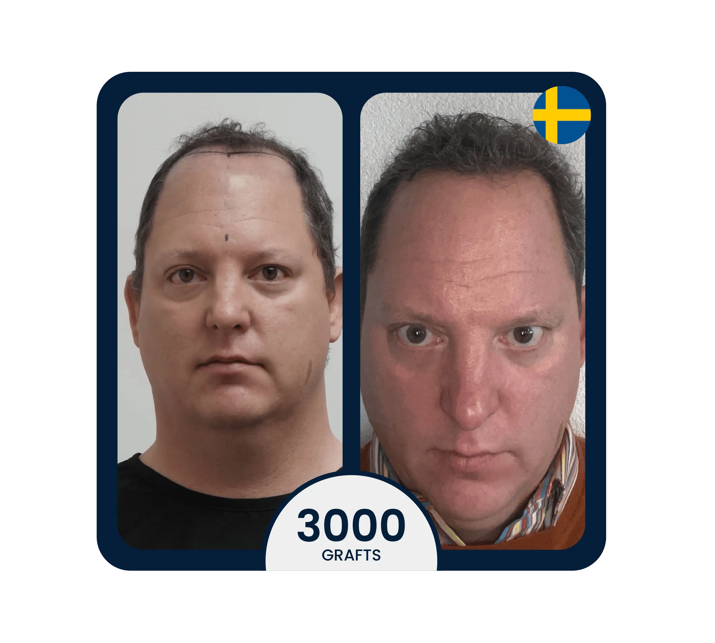 3000 graft hair transplant with stem cell hair growth result