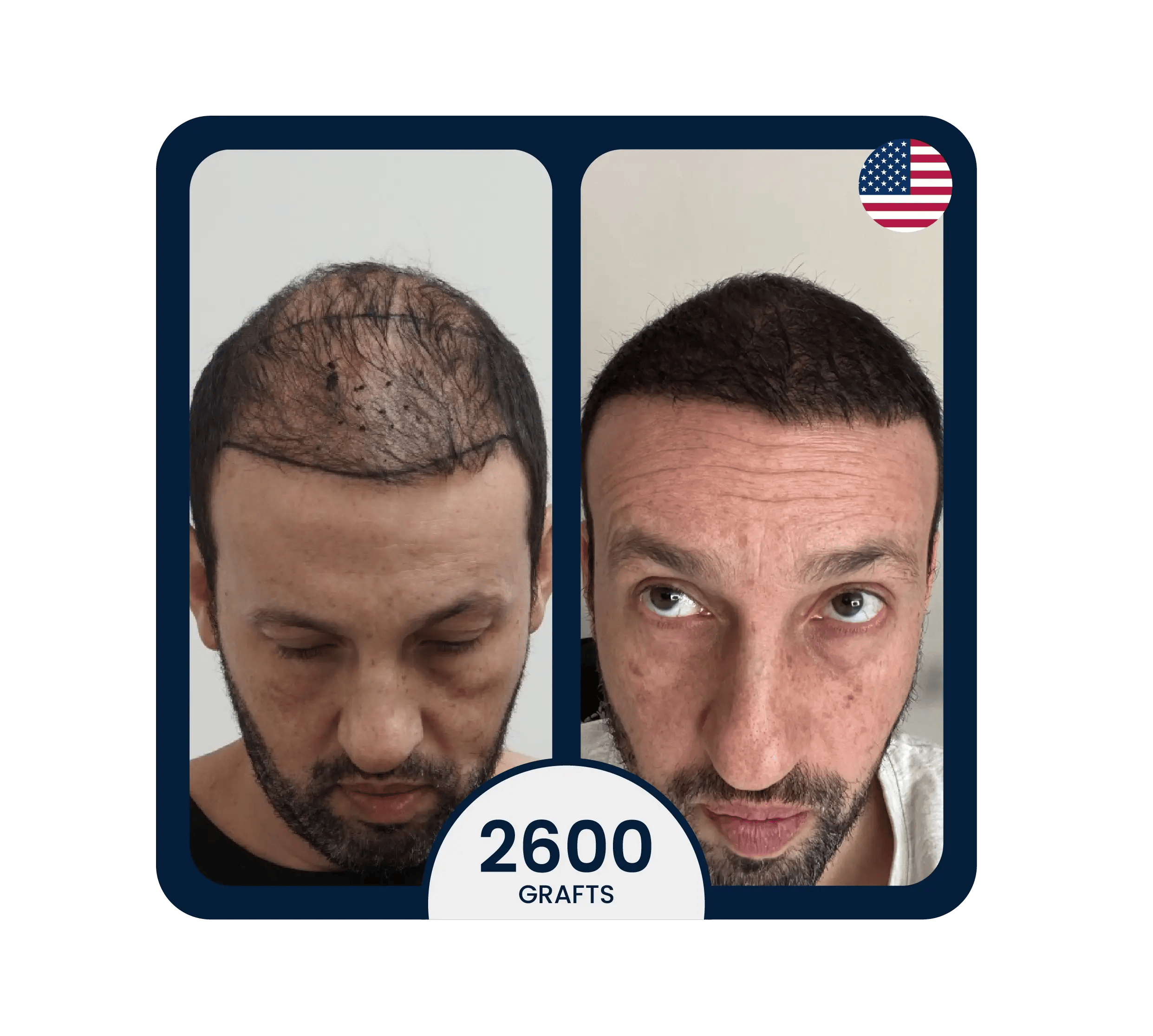 stem cell hair transplant result for 2600 grafts