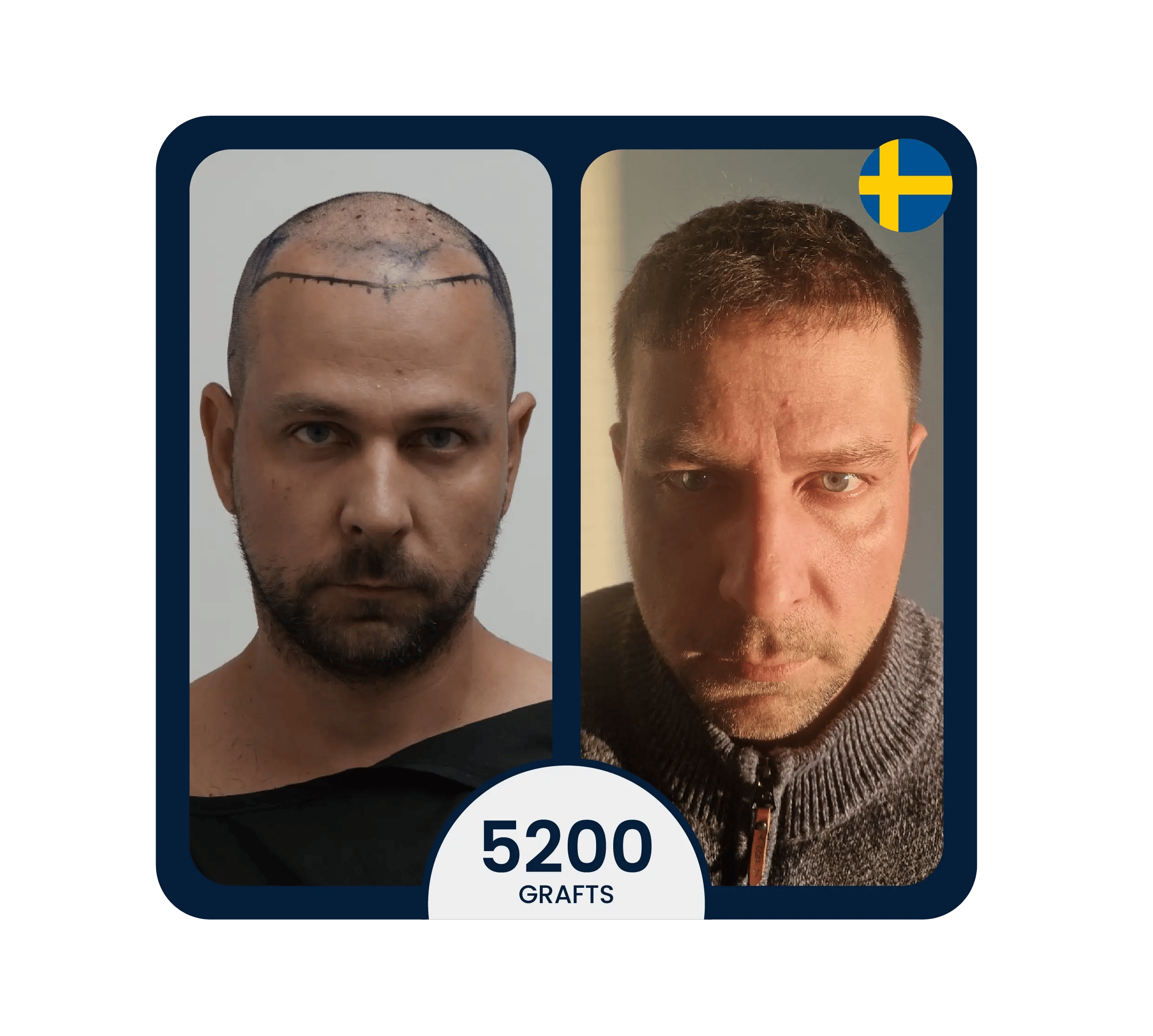 stem cell therapy supported hair transplant for 5200 light hair color