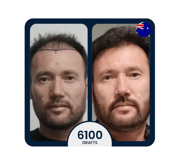 DHI hair transplant before after 6100 grafts