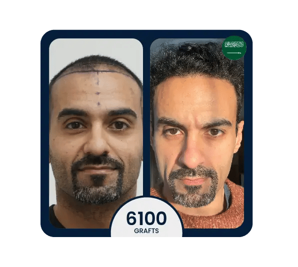 DHI hair transplant before after 6100 grafts eastern results