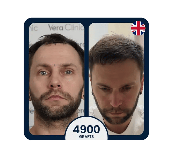 DHI hair transplant before after 4900 grafts uk