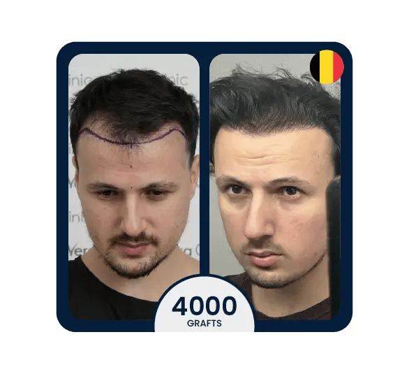 DHI hair transplant before after 4000 grafts germany