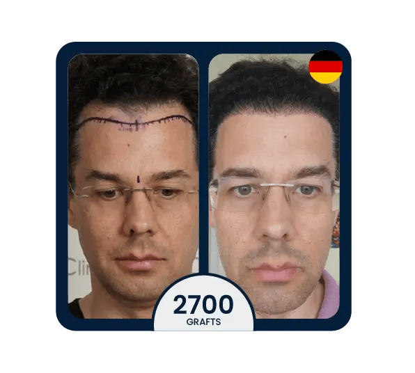 DHI hair transplant before after 2700 grafts