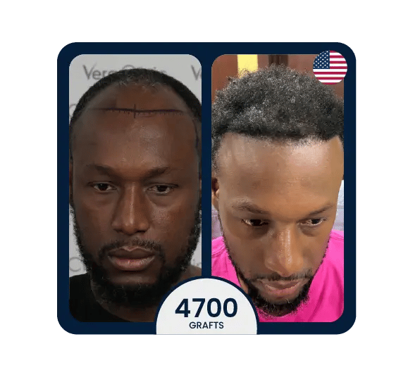DHI hair transplant before after 4700 grafts african-american results